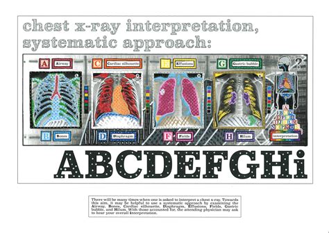 Chest X Ray Mnemonic Abcde at Don Browning blog