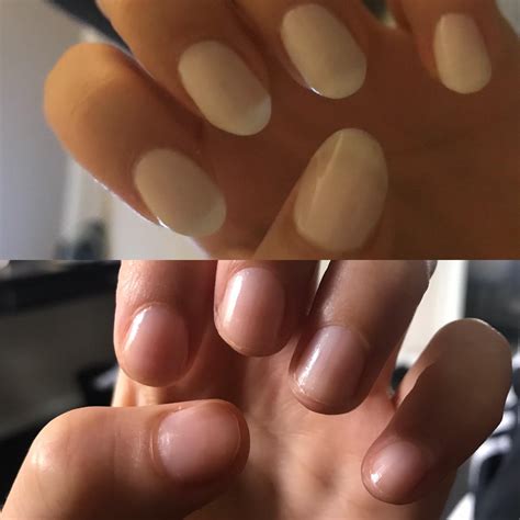 Relapsed after a few of my nails broke off , so annoying seeing them so