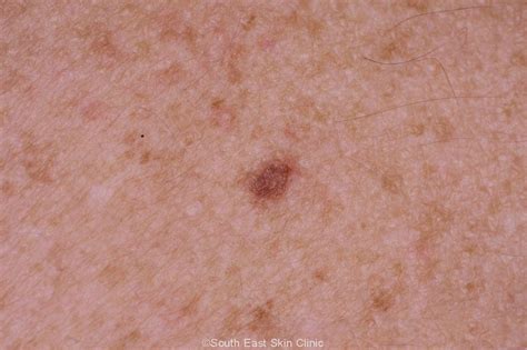 A Guide To The Atypical Mole - South East Skin Clinic