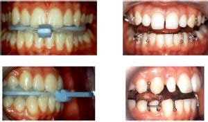 twin blocks orthodontic appliances official website  dr william clark