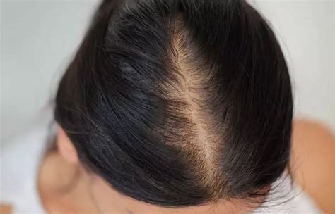 How To Fix Hair Breakage At The Crown