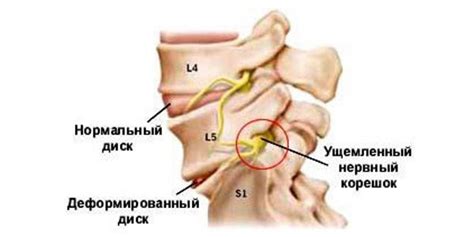 Что такое радикулит? Признаки, причины и его лечение