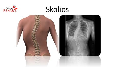Skolios - YouTube