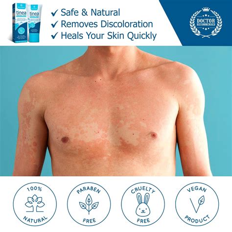 Tinea Versicolor Treatment Tinea Versicolor: Practice Essentials,