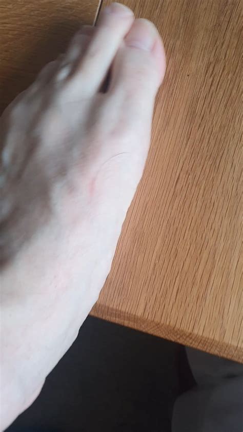 Hair Splinter from my Black Labrador : r/popping