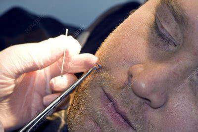 how to take care of stitches on face
