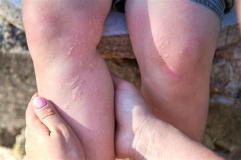 How to Quickly Soothe a Stinging Nettle Rash