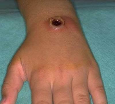 Health Teller: Anthrax