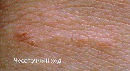 «Чесотка — первые признаки, лечение в домашних условиях» — Яндекс Кью