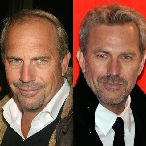 Chatter Busy: Kevin Costner Hair Transplant