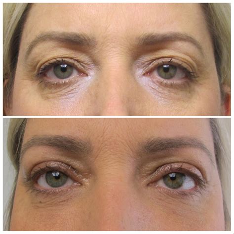 Eyelid Surgery in Long Island | Blepharoplasty with Dr. Doshi