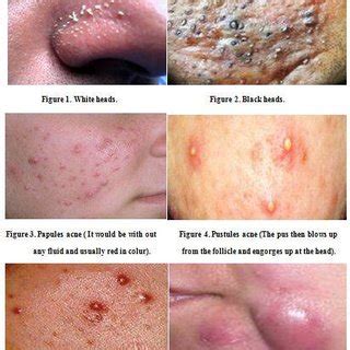 (PDF) ACNE-CAUSES AND AMAZING REMEDIAL MEASURES FOR ACNE