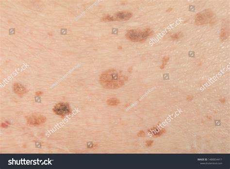 skin dark spots images stock  vectors shutterstock