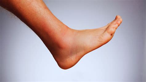 lateral foot pain  pain side  foot   treatment