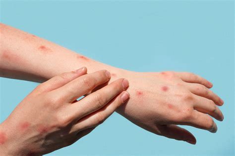 Doença Do Macaco Em Humanos - Monkeypox: tudo o que se sabe sobre a varíola do macaco até agora