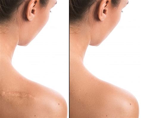 When to Consider Surgical Scar Removal: Surgical Associates of North ...