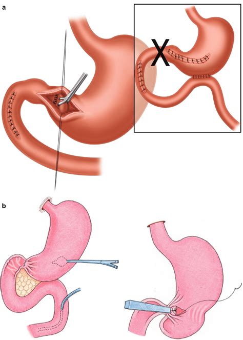 Exposures and Bowel Anastomosis for Trauma | Basicmedical Key