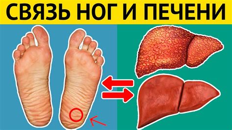 Как ноги сигнализируют о БОЛЕЗНЯХ ПЕЧЕНИ? Проверьте свои ноги! - YouTube