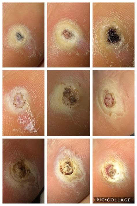 Plantar Wart Stages at Barbara Slye blog