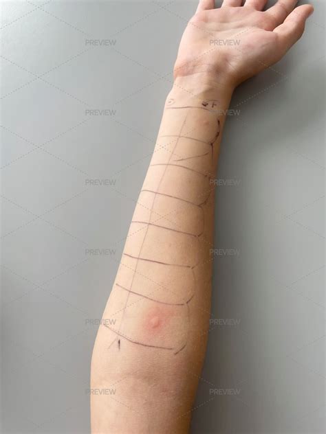 Prick Test For Inhalant Allergies - Stock Photos | Motion Array