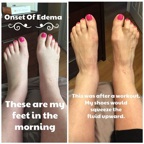 Why Is Only One Foot Swollen Pregnant at Wade Turner blog