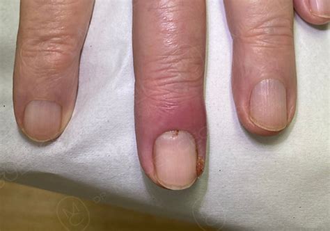 Panaricio ou unheiro (Paroníquia) | Dr Miguel Ceccarelli Dermatologista ...