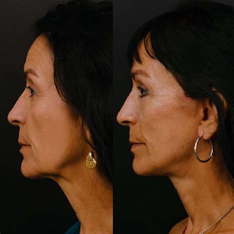 facelift surgery procedures donald  mowlds md