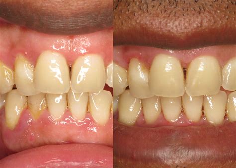 Laser Gum Surgery - Before & After Pictures