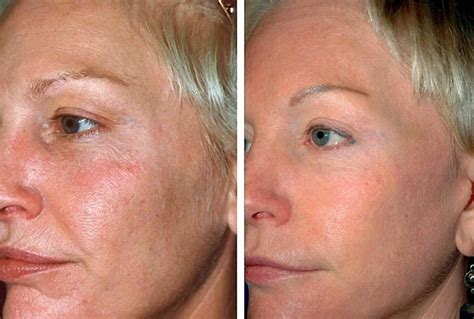 Fotona 4d Antes E Depois - Laser Fotona 4D Antes e Depois: Lifting Facial Não Invasivo à Laser ...