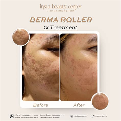 Treatment Derma Roller di Insta Beauty Center: Hanya dengan Satu Kali ...