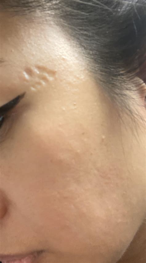 Damaged skin from getting cellulitis on my face from a few years ago