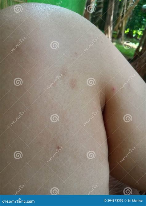 Insect Bite Marks on Human Skin. Stock Photo - Image of person, male