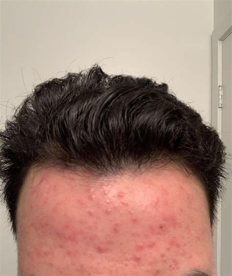 Die off with ivermectin topical 1% : r/Rosacea
