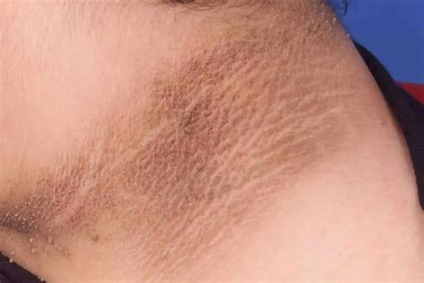 acanthosis nigricans creams  dark neck removal