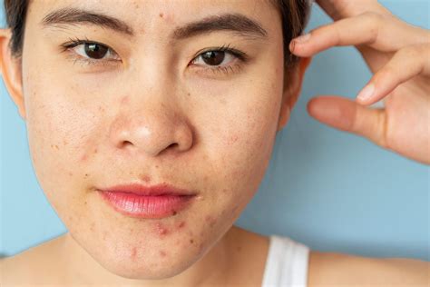 rid   types  acne   derms