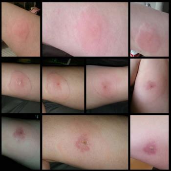 What Does A Recluse Spider Bite Look Like At First