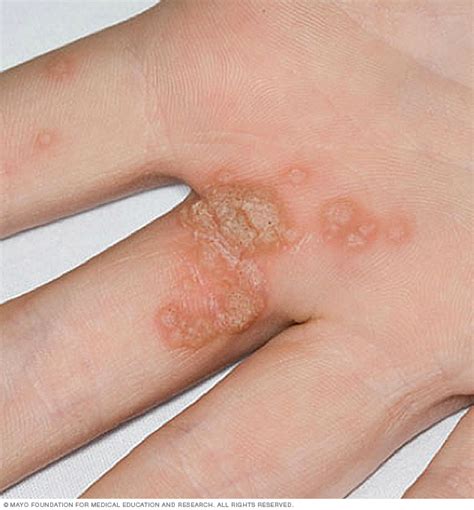 common warts disease reference guide drugscom