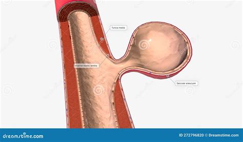 majority  brain aneurysms  saccular aneurysms