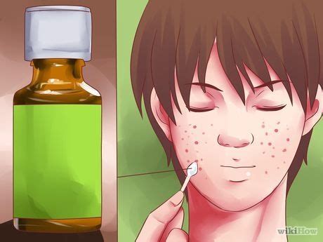 How to get rid of a zit overnight with pictures – Artofit