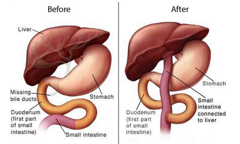 Biliary Atresia; Diagnosis, Symptoms, Treatment & Kasai Procedure