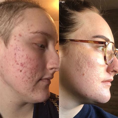 before and after chemo cream face 2