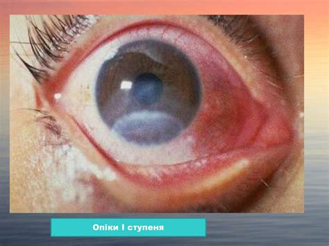 Пошкодження ока та його додаткового апарату, клініка, невідкладна ...