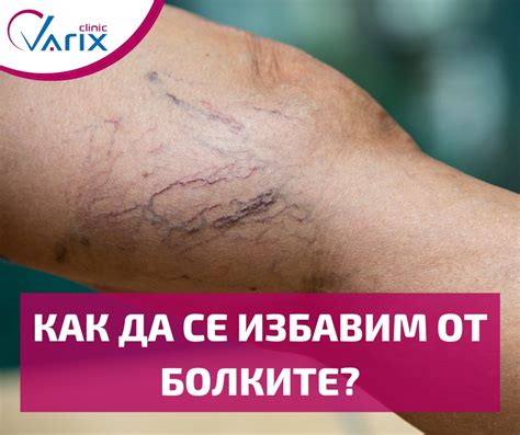 Varix Clinic - венозен лазерен център - Home | Facebook