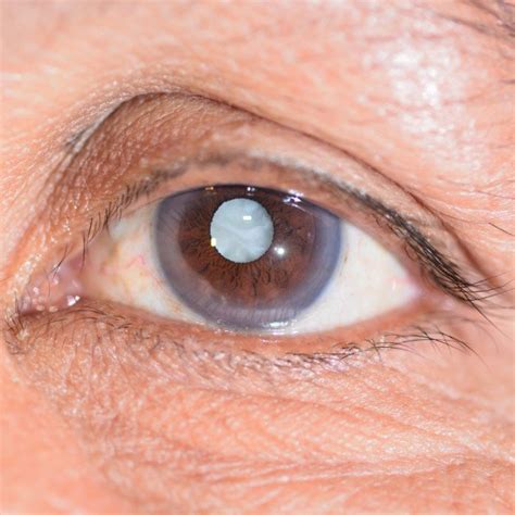cataract treatment cataract surgeon  consultant dr dory neu ner
