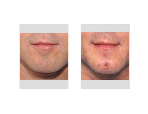 Cleft Chin Before And After