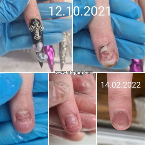 Помощь при термических, химических и физических травмах ногтя — Центре ...