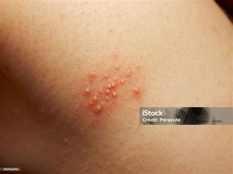Rash And Other Nonspecific Skin Eruption Stock Photo - Download Image ...