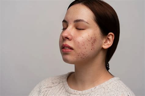 Acne Scar Treatment Strategies That Dermatologists Recommend | I Love