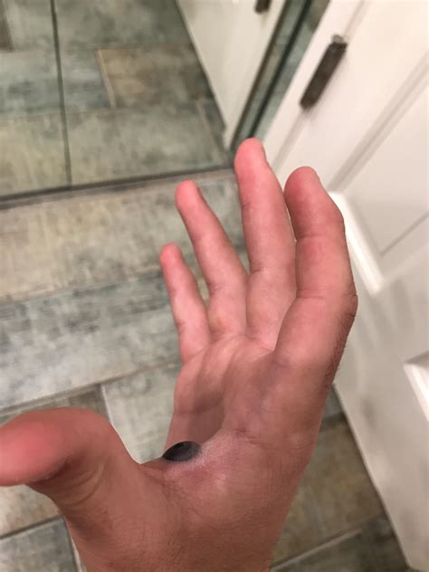 Would popping this help? Blood blister : r/popping