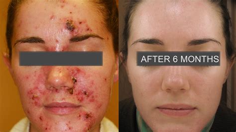 mild psoriasis on face - pictures, photos